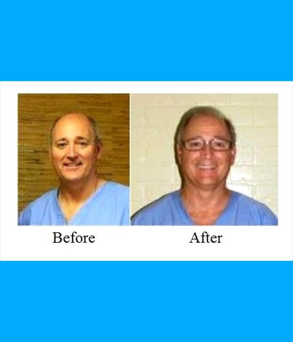 Patient Hair Transplant Cost is $2,400.00