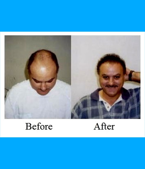  Patient Hair Transplant Cost is $3,000.00