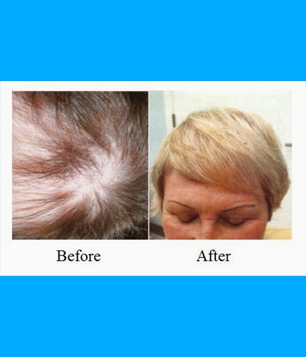  Patient Crown Hair Transplant Cost is $2,800.00