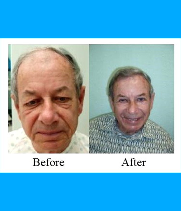  Patient Hair Transplant Cost is $3,800.00  Mini Face Lift Cost is $3,200.00