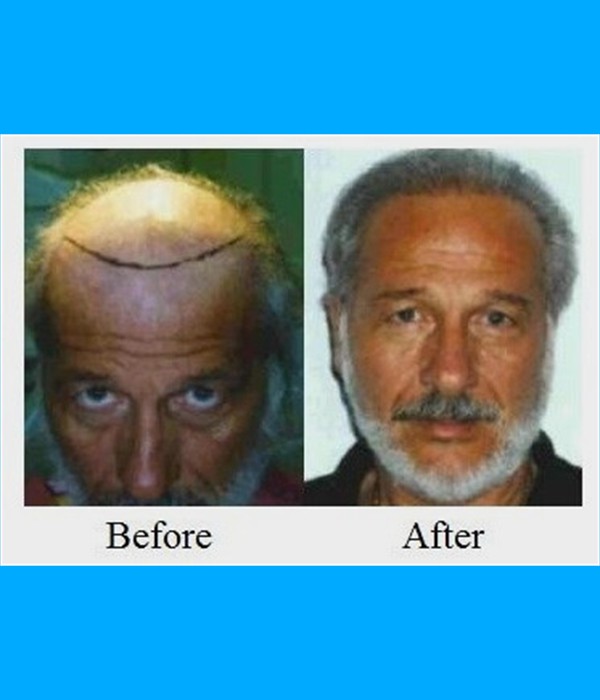  Patient Hair Transplant Cost is $4,500.00